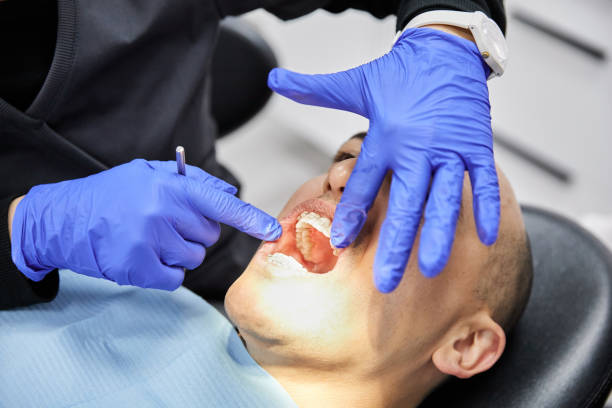 Best Emergency Wisdom Tooth Extraction in Mbrian Park, CA
